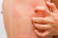 Fake news sull'orticaria, l'immunologo: