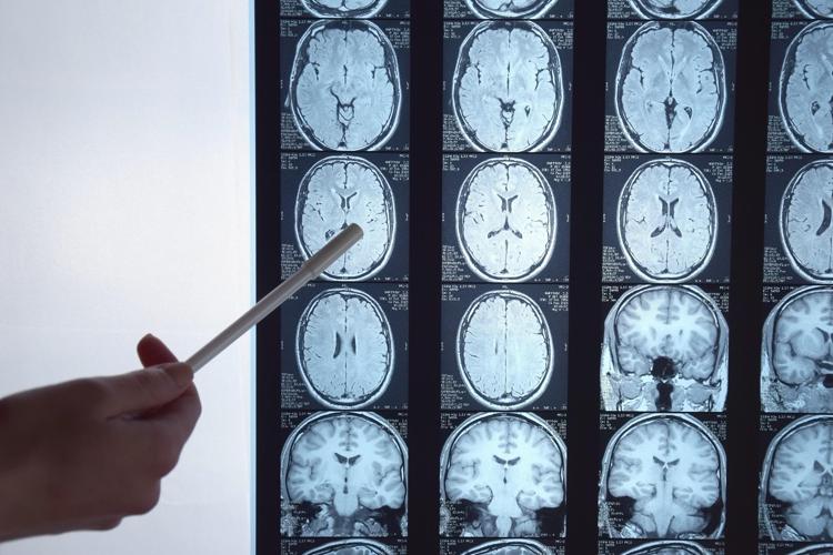 Radiografia del cervello - (Foto 123RF)