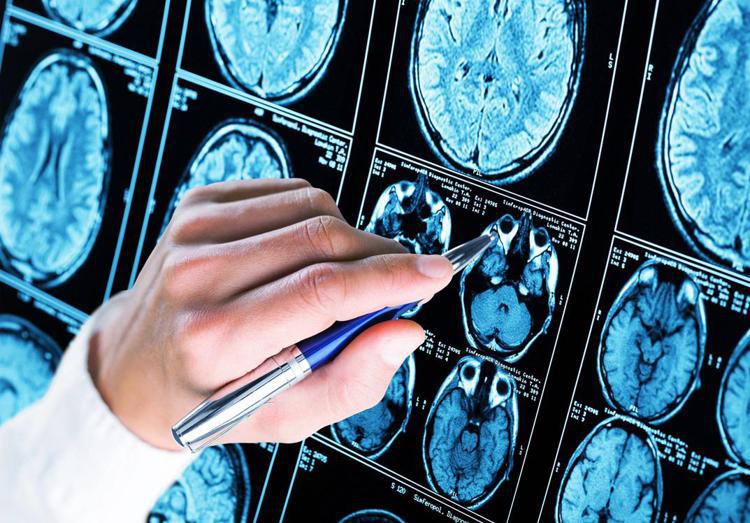 Esami per individuare tracce di Alzheimer