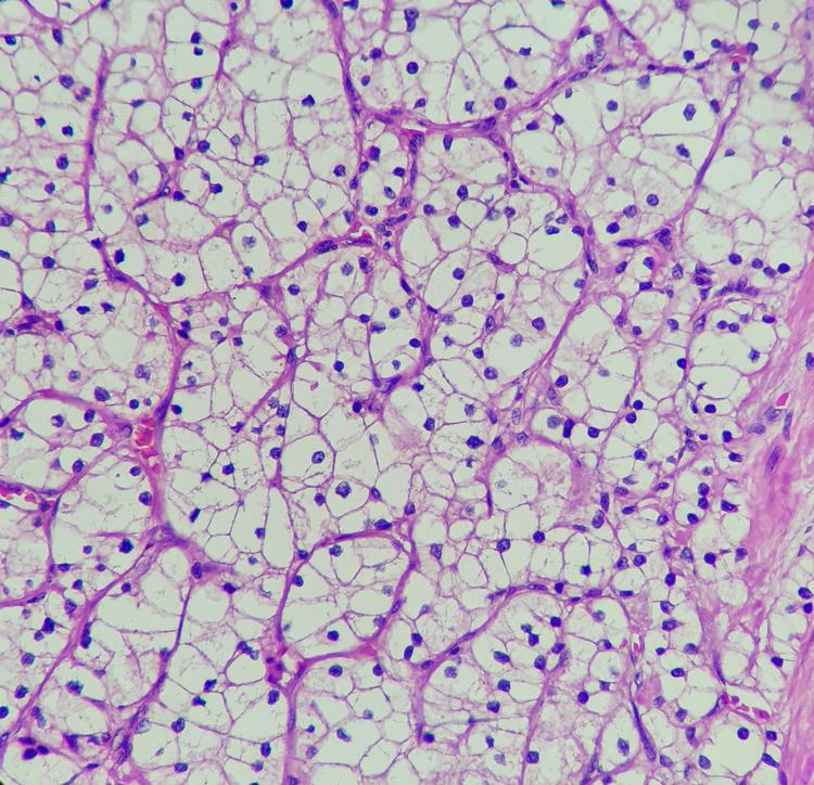 Studio, Tki e immunoterapia più efficace di sunitinib in carcinoma a cellule renali