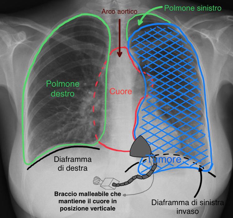 Nella foto la massa tumorale del paziente