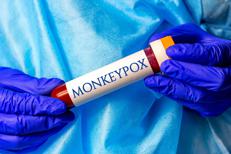 Provetta sangue con virus Mpox  -