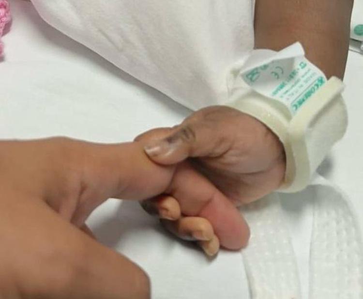 Gemelline siamesi del Burkina Faso operate al Gaslini